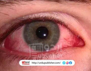 گلابی آنکھ کی وبا