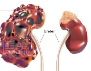 Polycystic Kidney Disease - PKD)