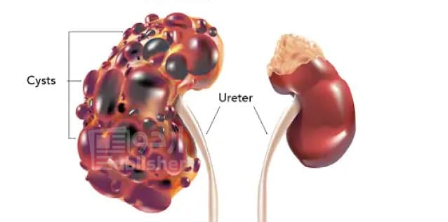 Polycystic Kidney Disease - PKD)